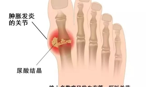 脚底出汗发冷是什么原因-专业脚底出汗怎么治疗最有效平台-脚底出汗湿漉漉的怎么回事